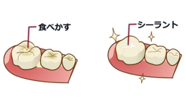 シーラント処置