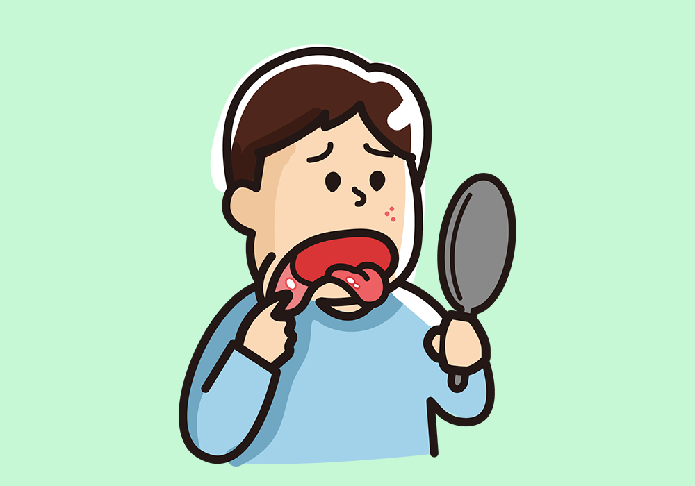 口内炎